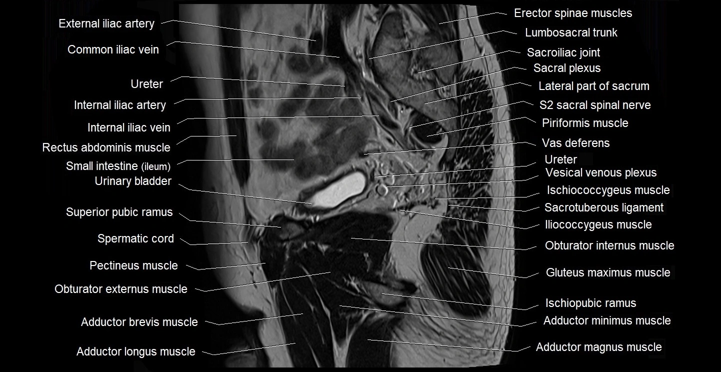 male pelvis sagittal cross sectional anatomy 3T mri image 33.webp